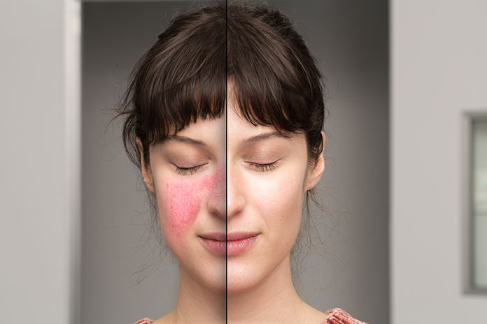 Trądzik różowaty - kobieta przed i po leczeniu
