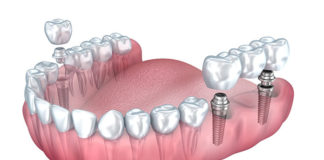 Jakie implanty zębowe wybrać i gdzie wykonać zabieg?